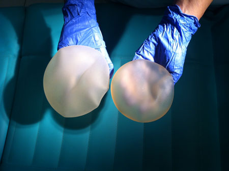 Implantes y silicona se vienen utilizando desde 1960