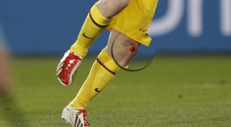 lesion_messi_0