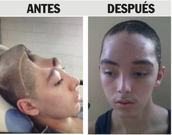 Intervenciones quirúrgicas gratuitas de patologías y malformaciones craneofaciales o maxilofaciales, son realizadas por la Fundación Sonrisas por Venezuela  