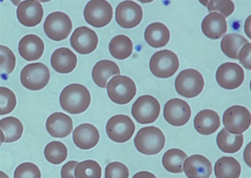 Imagen de junio de 2014 provista por los Institutos Nacionales de Salud de EEUU donde se ven glóbulos rojos tras un trasplante de médula. Un pequeño pero prometedor estudio del gobierno concluyó que los trasplantes de médula ósea pueden revertir la anemia falciforme. (Foto AP/Institutos Nacionales de Salud)