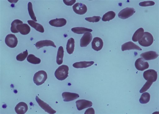 Imagen de junio de 2014 provista por los Institutos Nacionales de Salud de EEUU donde se ven glóbulos de un paciente con anemia falciforme. Un pequeño pero prometedor estudio del gobierno concluyó que los trasplantes de médula ósea pueden revertir la anemia falciforme. (Foto AP/Institutos Nacionales de Salud)