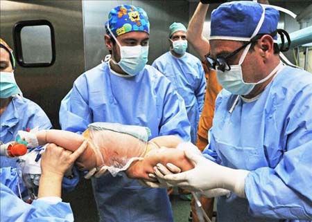 La última operación de este tipo en Chile se produjo hace un año, cuando se logró separar a dos siamesas de diez meses de vida que estaban unidas por el tórax, abdomen y pelvis. En la imagen el registro de otra operación de similares características.