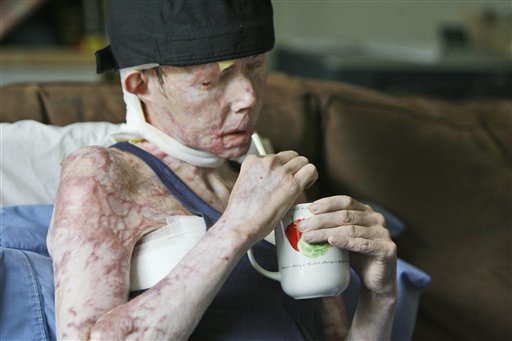 Carmen Tarleton en su casa en Vermont, en agosto de 2008. La mujer sufrió quemaduras en 80% de su cuerpo cuando su ex esposo le roció lejía industrial y la golpeó con un bate en 2007. Foto AP