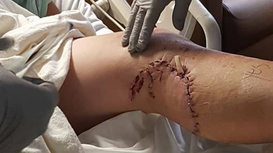 Cody High, de 15 años, se recupera de una supuesta mordida de un tiburón en su pierna izquierda, mientras disfrutaba con su familia en una playa del sur de la Florida. GoFundMe.SUR DE LA FLORIDA