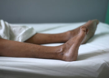 The legs of a patient suffering from the Guillain-Barre neurological syndrome recovering in the neurology ward of the Rosales National Hospital in San Salvador, on January 27, 2016. Health authorities have issued a national alert against the Aedes aegypti mosquito, vector of the Zika virus which might cause microcephaly and Guillain-Barré syndrome. AFP PHOTO / Marvin RECINOS / AFP / Marvin RECINOS