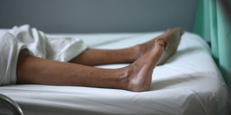 The legs of a patient suffering from the Guillain-Barre neurological syndrome recovering in the neurology ward of the Rosales National Hospital in San Salvador, on January 27, 2016. Health authorities have issued a national alert against the Aedes aegypti mosquito, vector of the Zika virus which might cause microcephaly and Guillain-Barré syndrome. AFP PHOTO / Marvin RECINOS / AFP / Marvin RECINOS